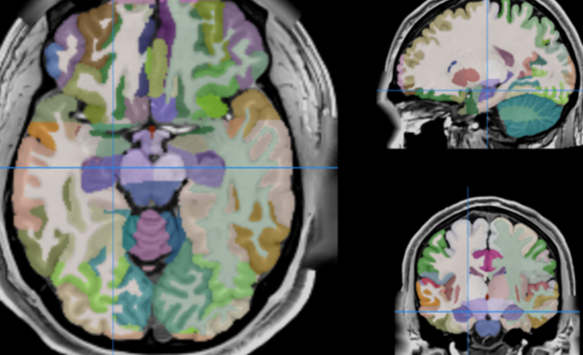 VOLBRAIN : Software to analyze mMRI brain data. It provides a report ...